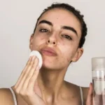 Acne Prone SkinCare Products